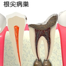 根尖病巣